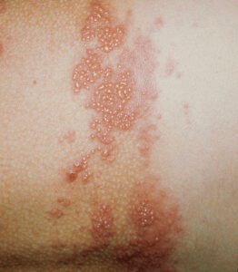 Skin Disease
